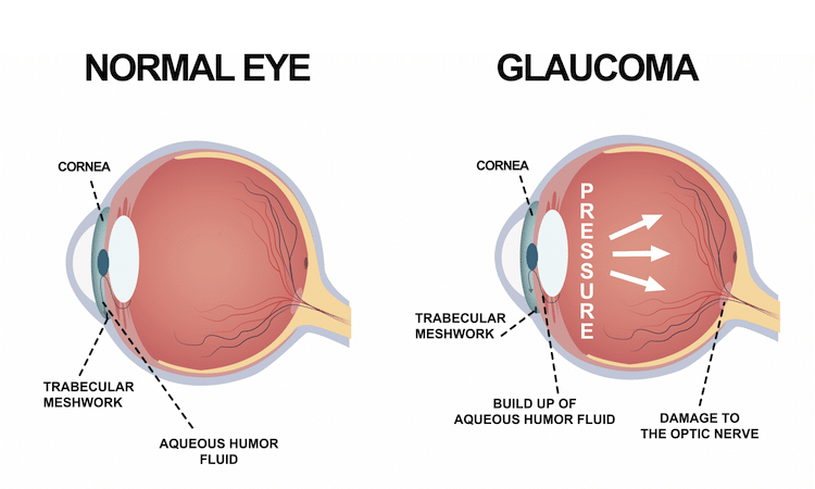 glaucoma-cure-sight-laser-center