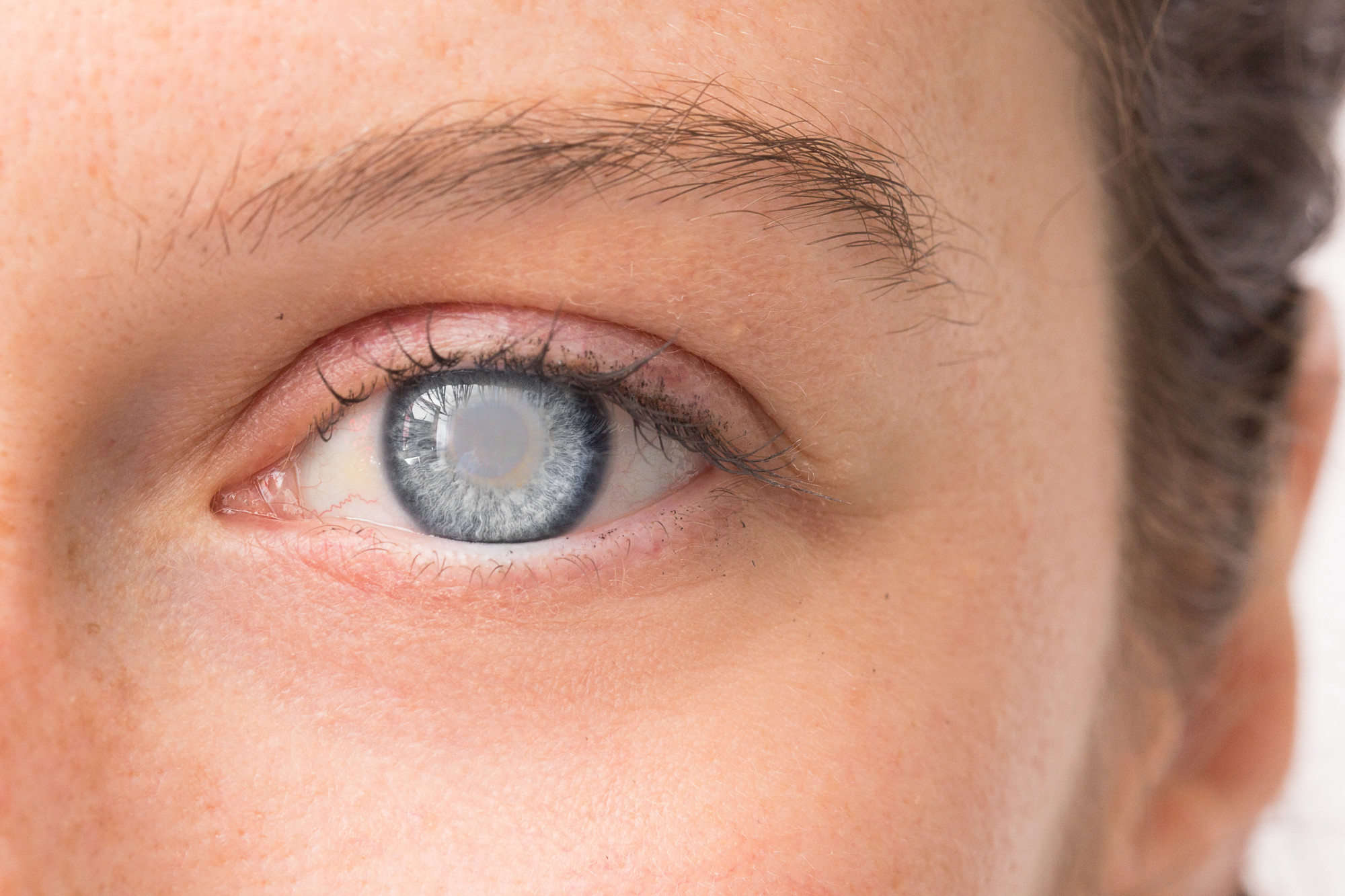 Cataract Cure Sight Laser Center