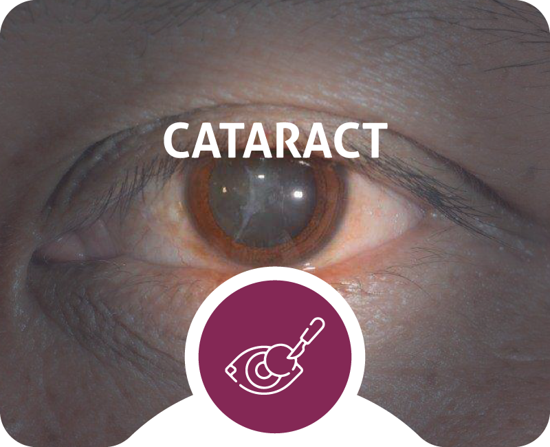CSLC_HomePage_Cataract_1