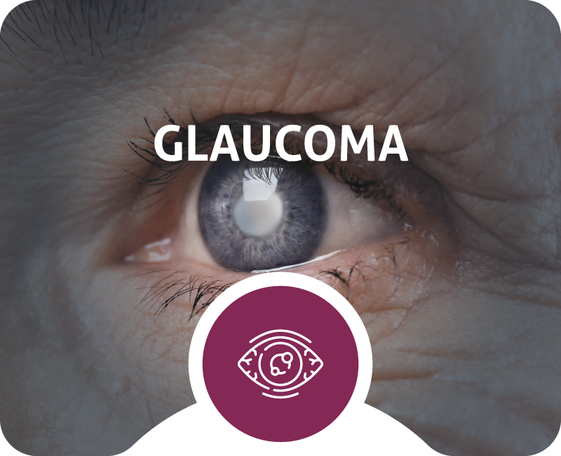 CSLC_HomePage_Glaucoma_1