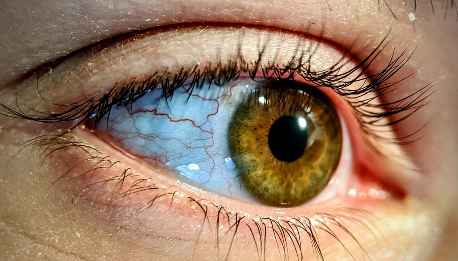 ICL eye Surgery in ahemdabad